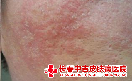 皮炎概述