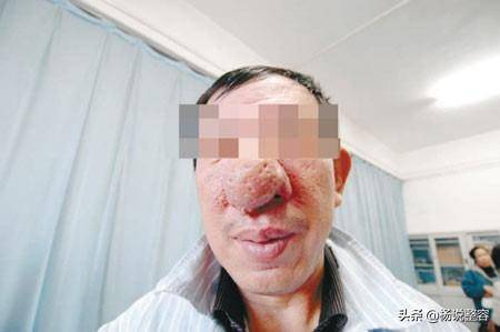 酒渣鼻最新论述深度解析，观点阐述与深度分析