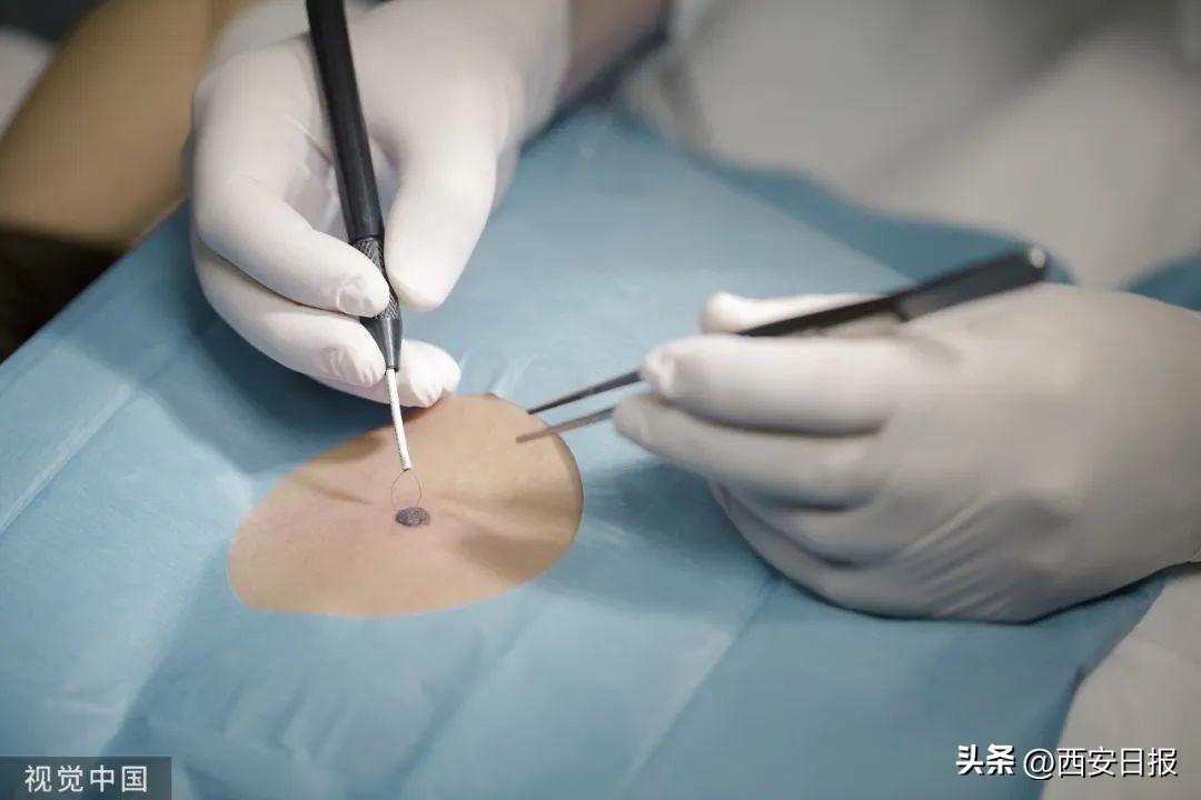 黑色素痣切除价格