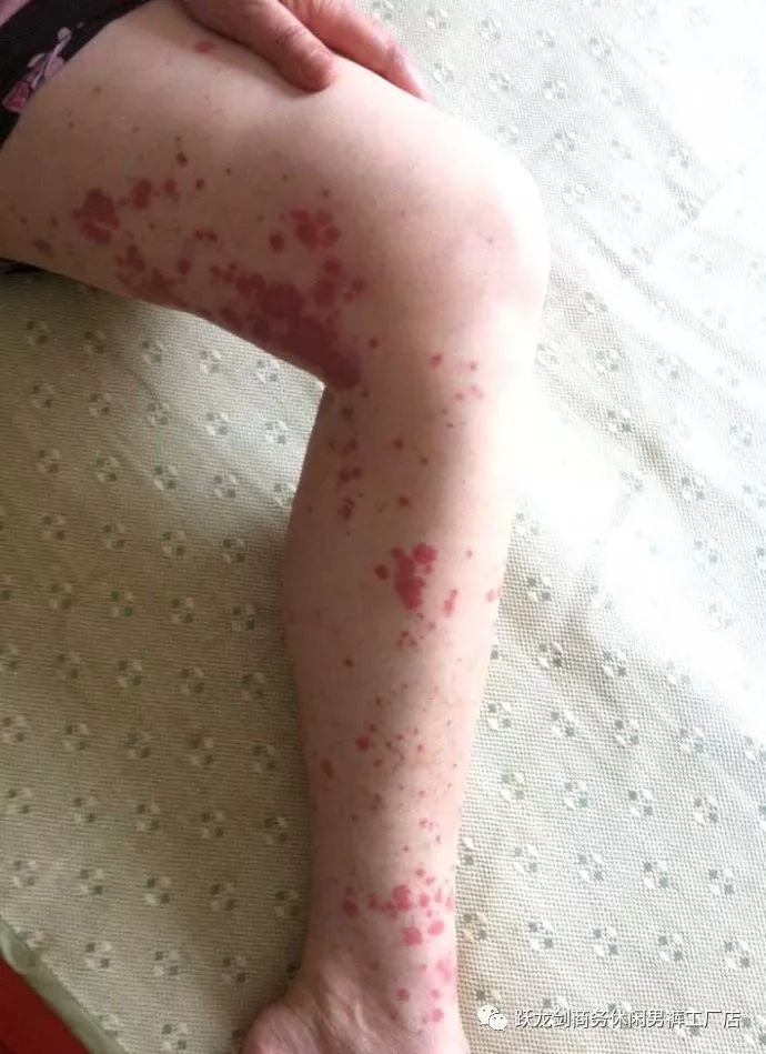 紫癜贴吧最新动态