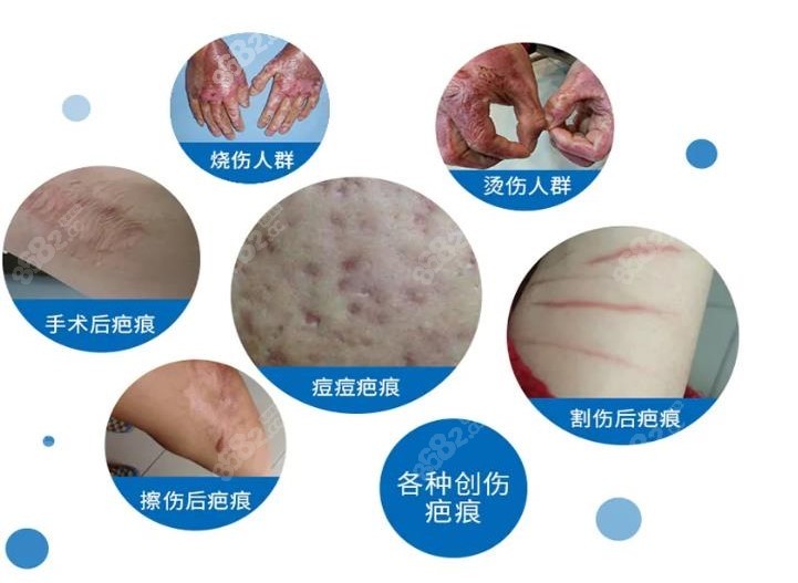 最新祛疤技术，时代进步的见证，个体希望的曙光